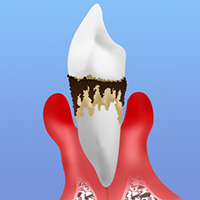末期の歯周炎
